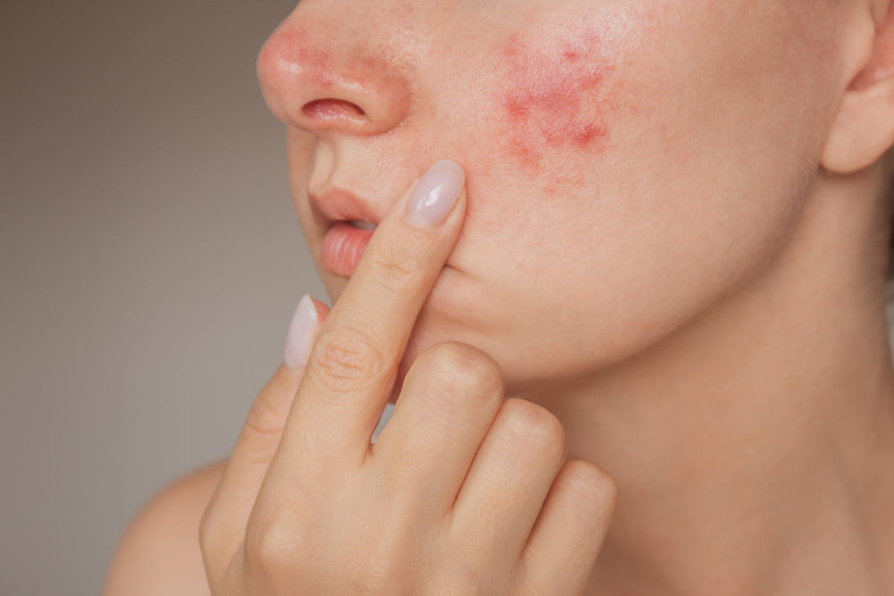 Rosacea Skincare Solutions: How to Calm Redness and Irritation