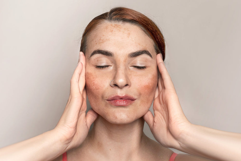 Hyperpigmentation Treatment: How to Achieve Even Skin Tone