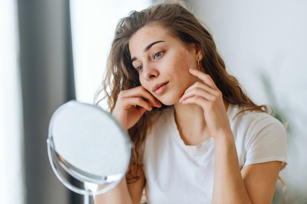 Effective Acne Treatment Products: What to Look For